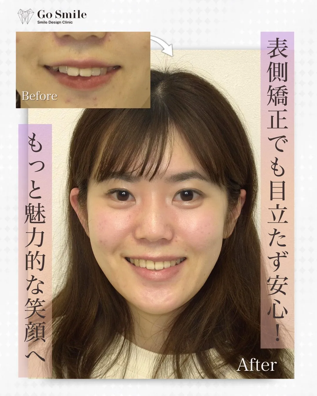 表側矯正でも目立たず安心！