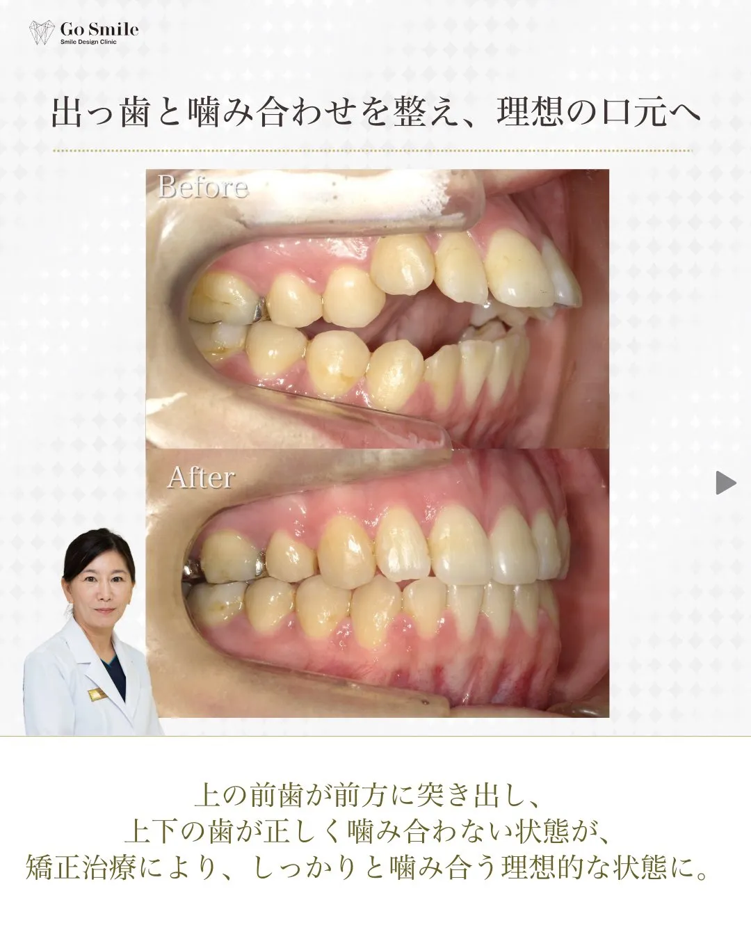 表側矯正でも目立たず安心！