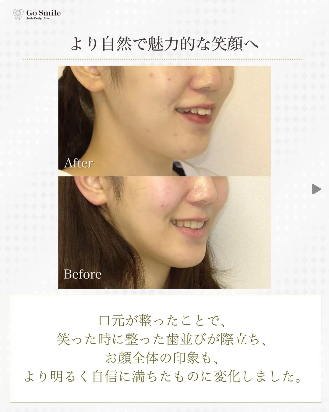 表側矯正でも目立たず安心！