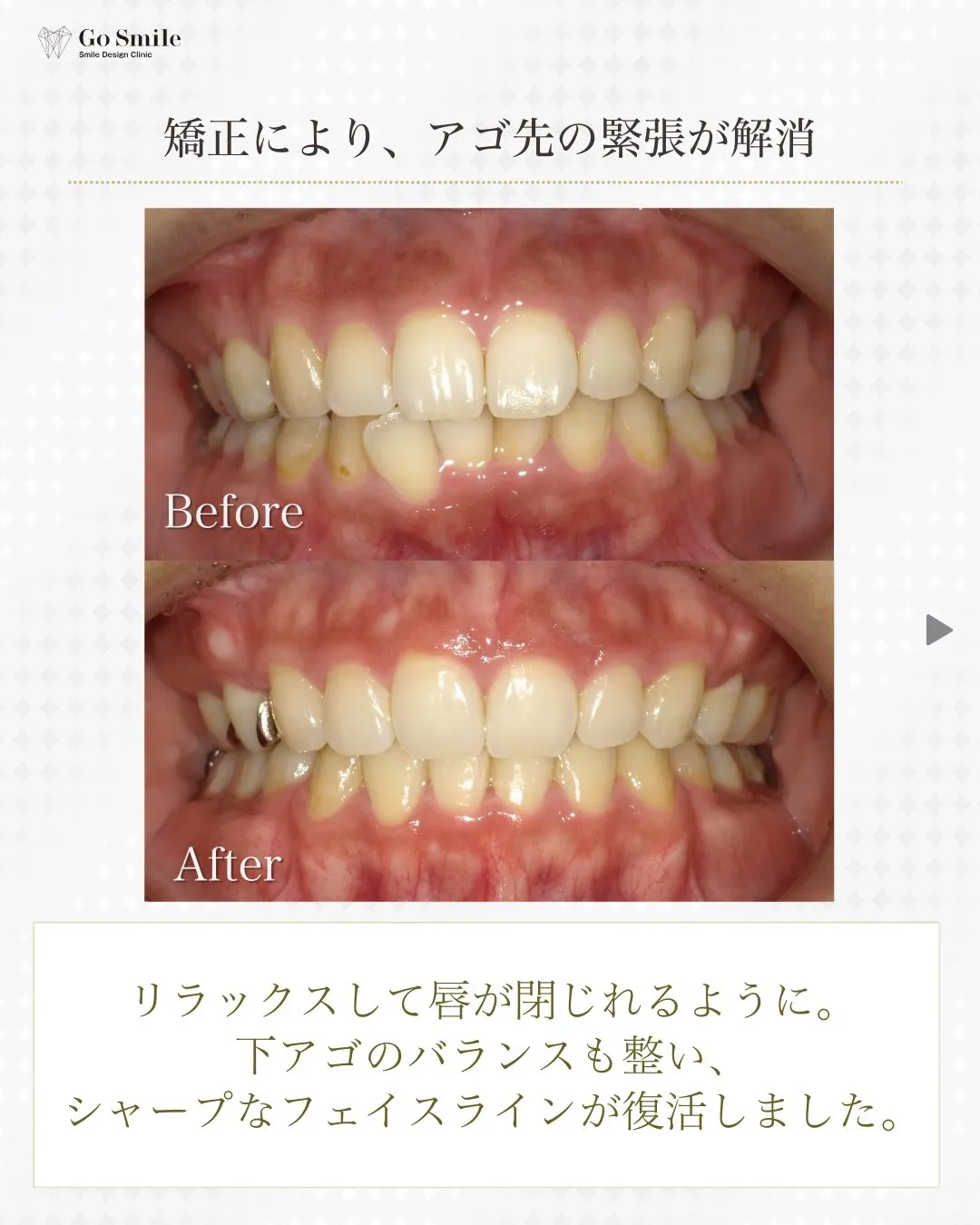 歯並びだけじゃない！