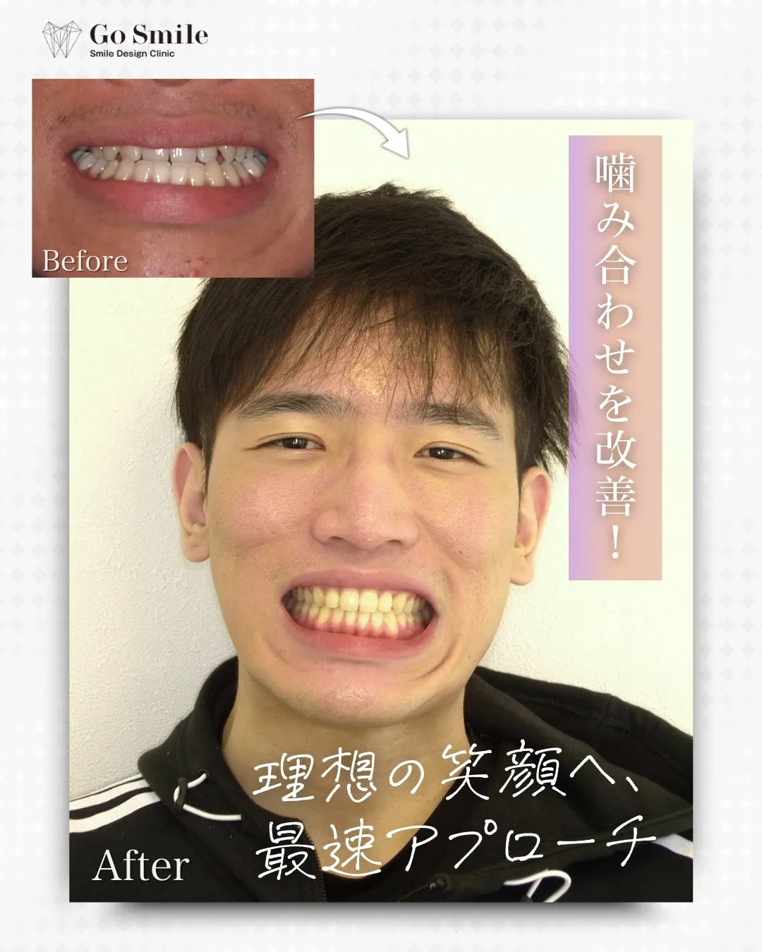 噛み合わせを改善！