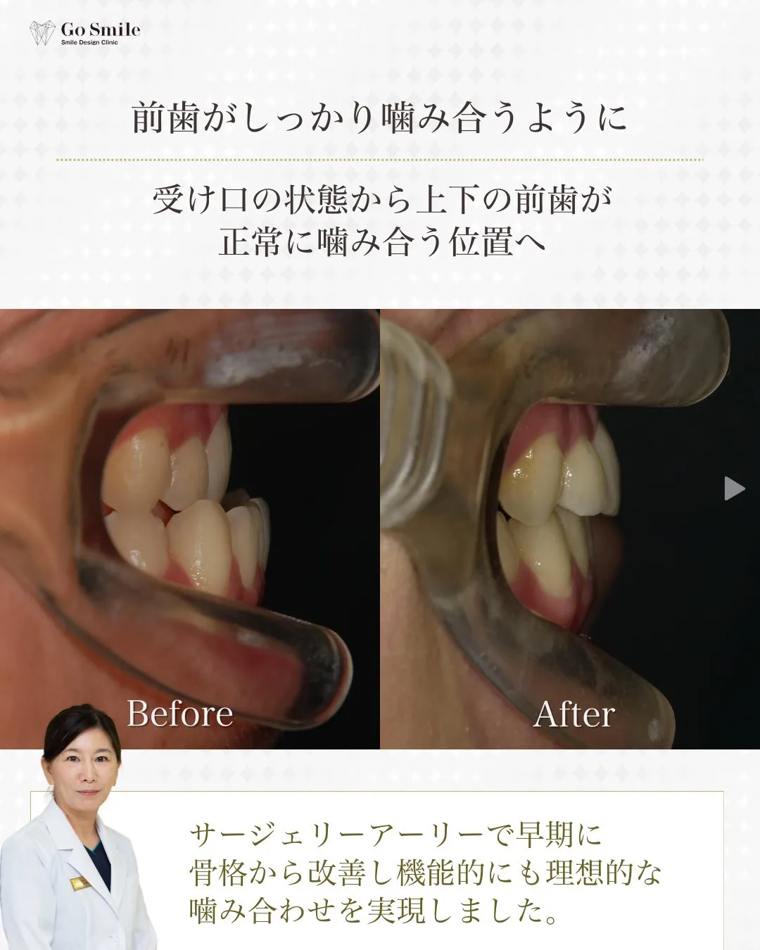 噛み合わせを改善！