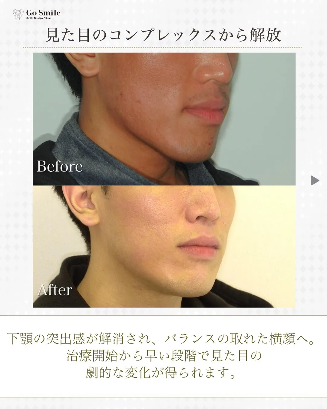 噛み合わせを改善！