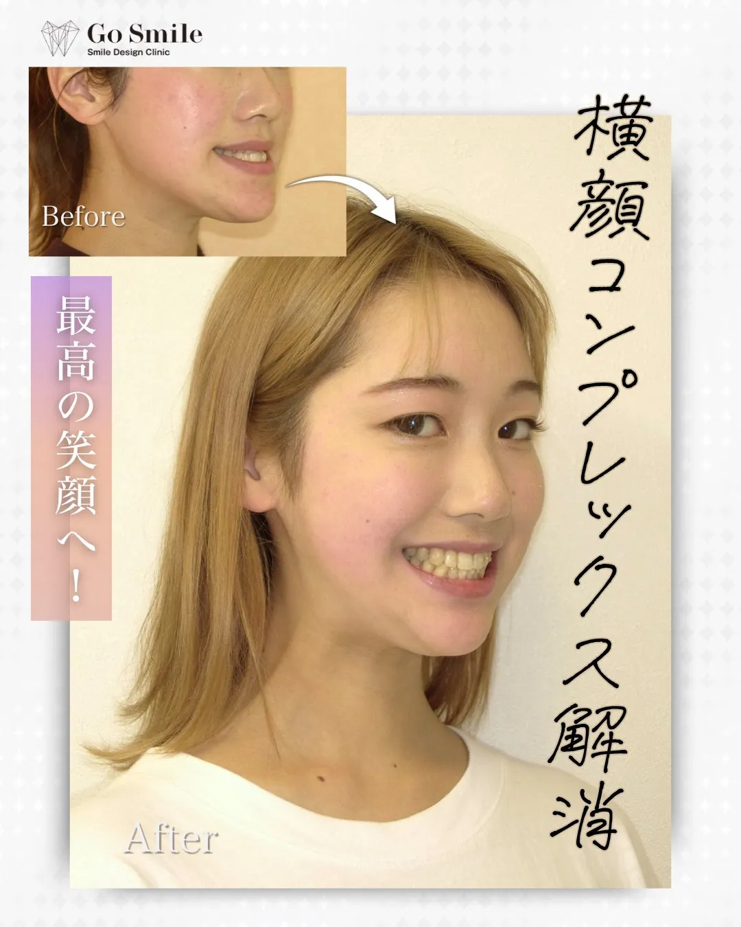 横顔コンプレックス解消で