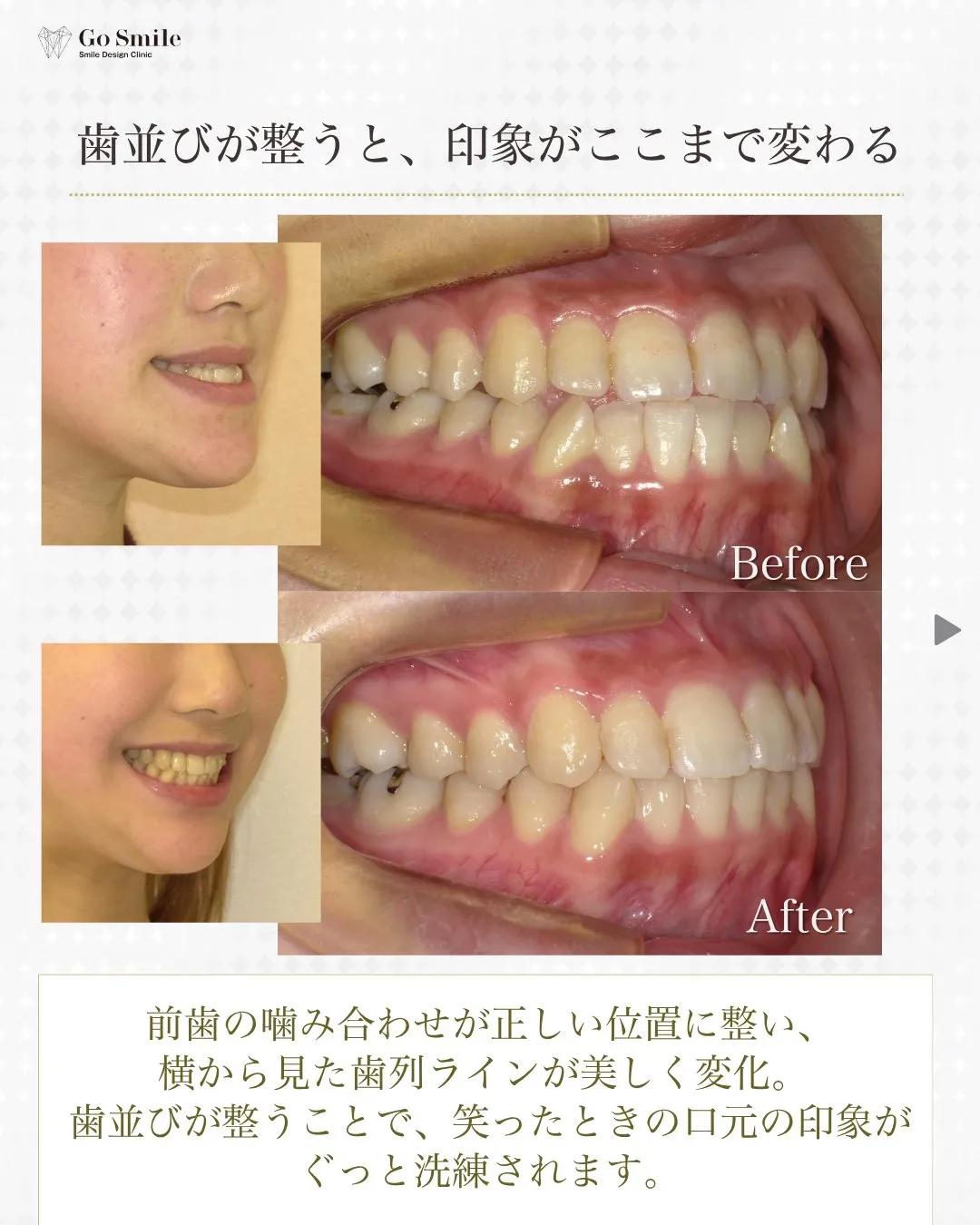 横顔コンプレックス解消で