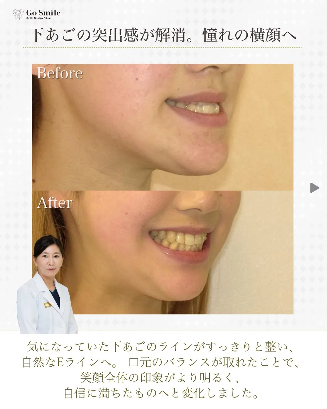 横顔コンプレックス解消で