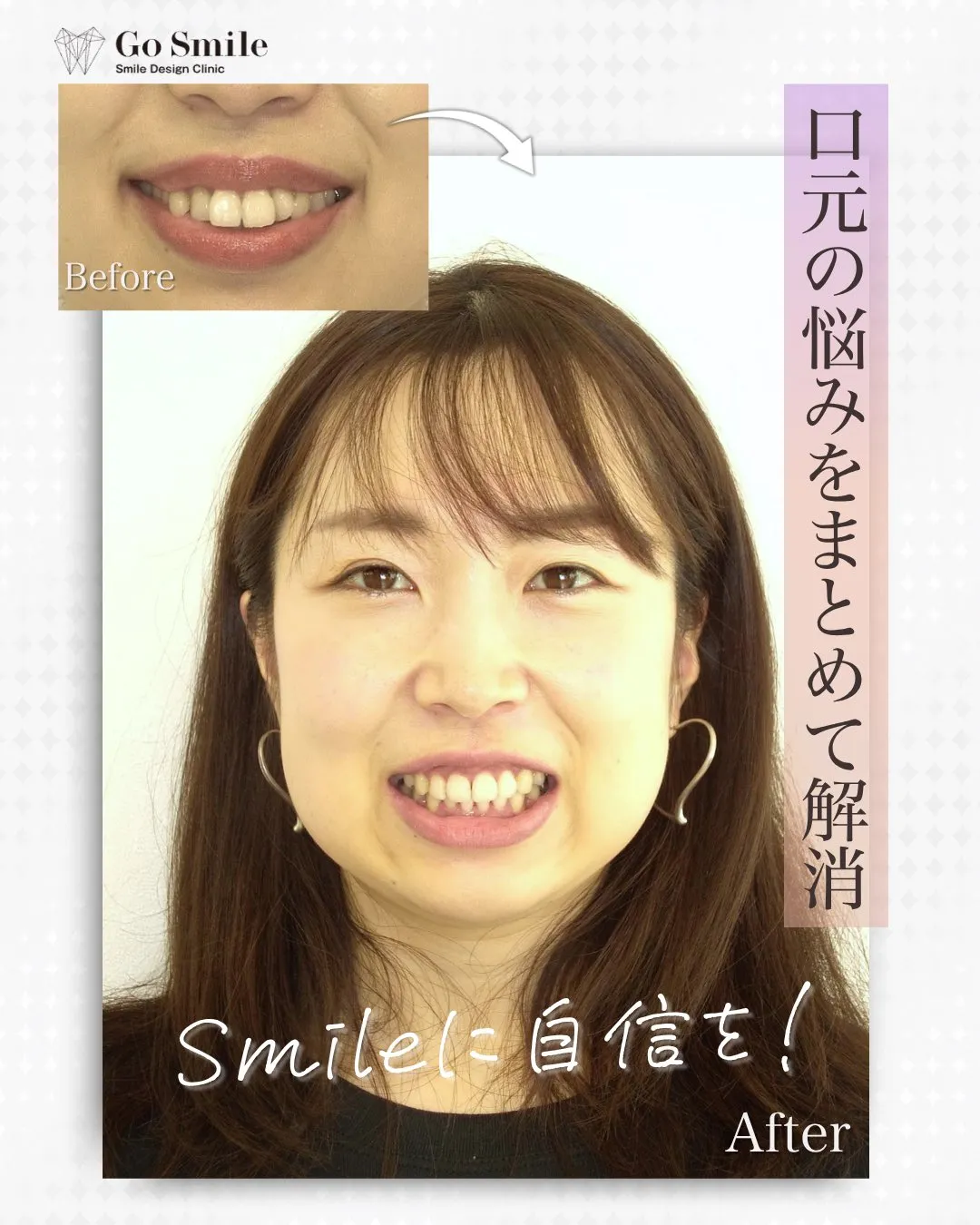 Smileに自信を！