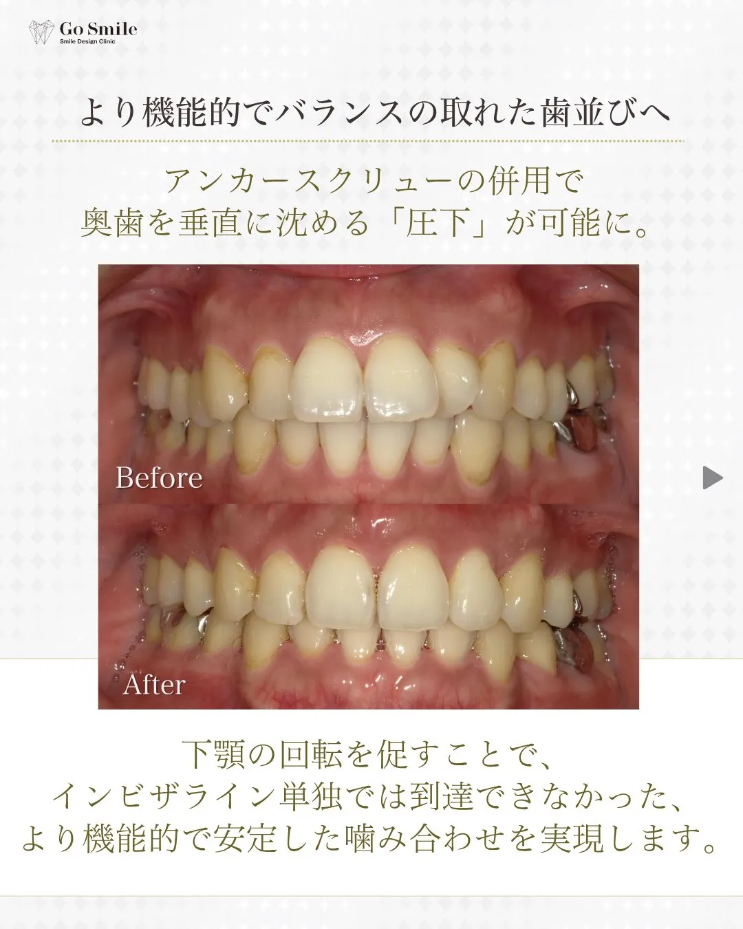Smileに自信を！