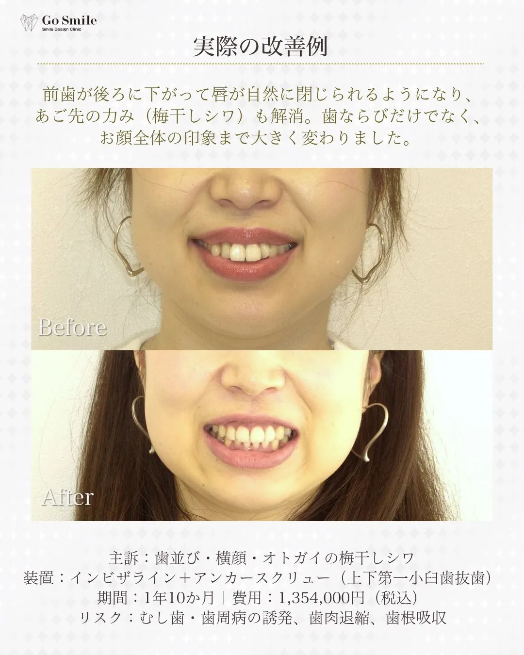 矯正だけじゃ垢抜けない？