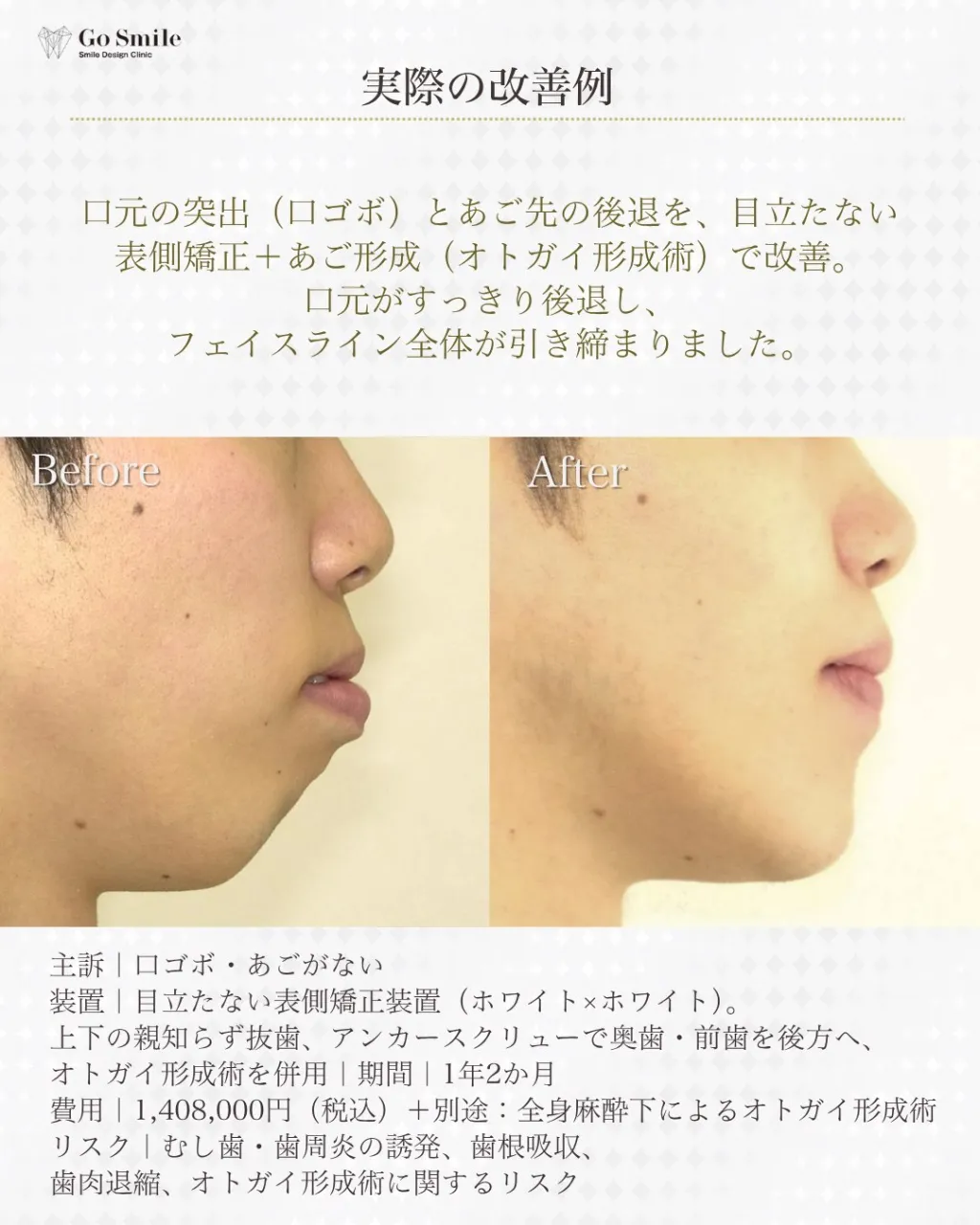 フェイスラインは口元から整える