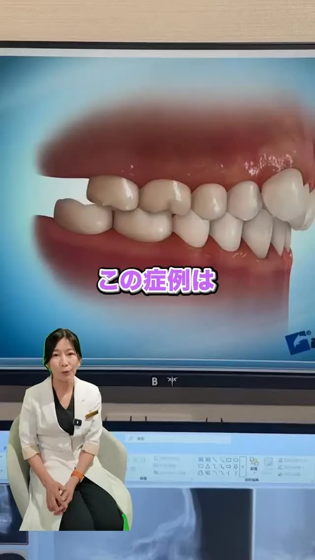 こんなネジが埋まっているんです！！#矯正歯科gosmile横...