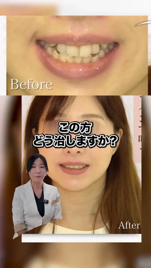 矯正で口元の印象がこんなにも変わるんです！#矯正歯科gosm...