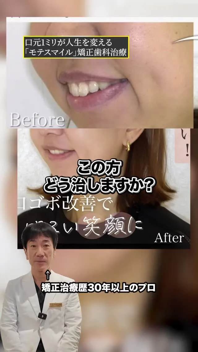口ゴボもここまで綺麗に改善するんです！#矯正歯科gosmil...