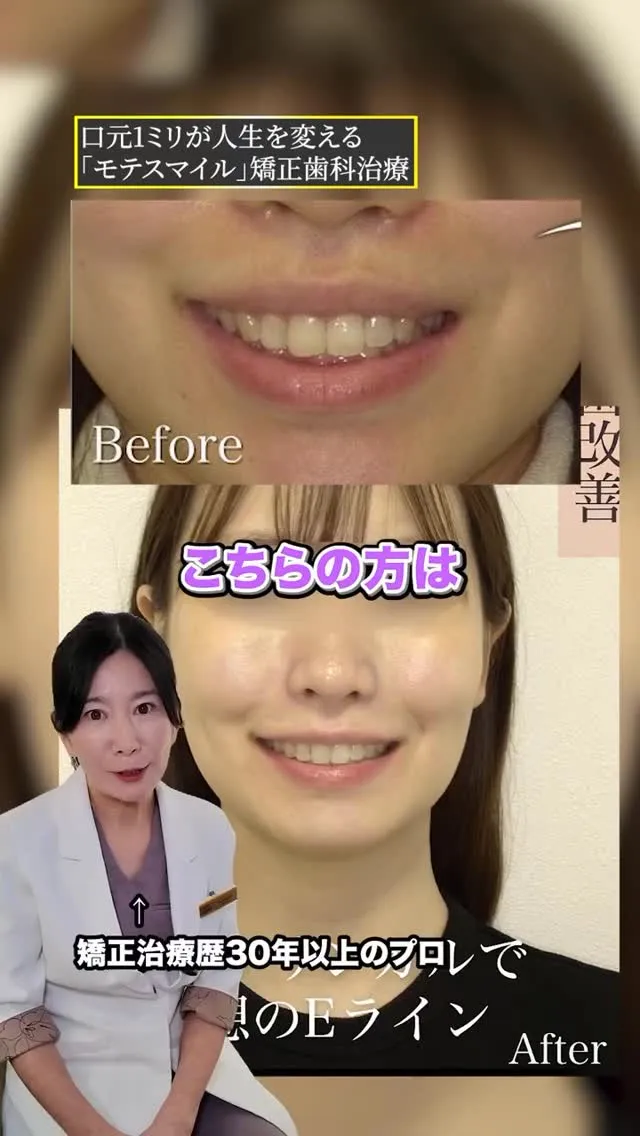 見た目以上に効果が感じられるのが矯正です！#矯正歯科gosm...