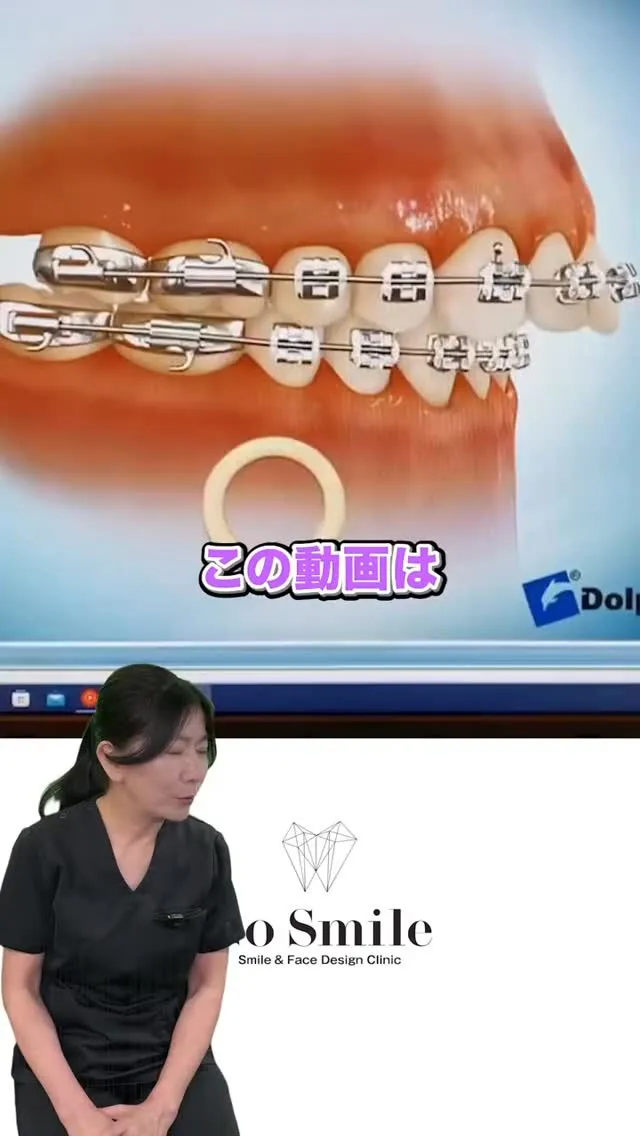 ゴムかけやったことありますか？？#矯正歯科gosmile横浜...