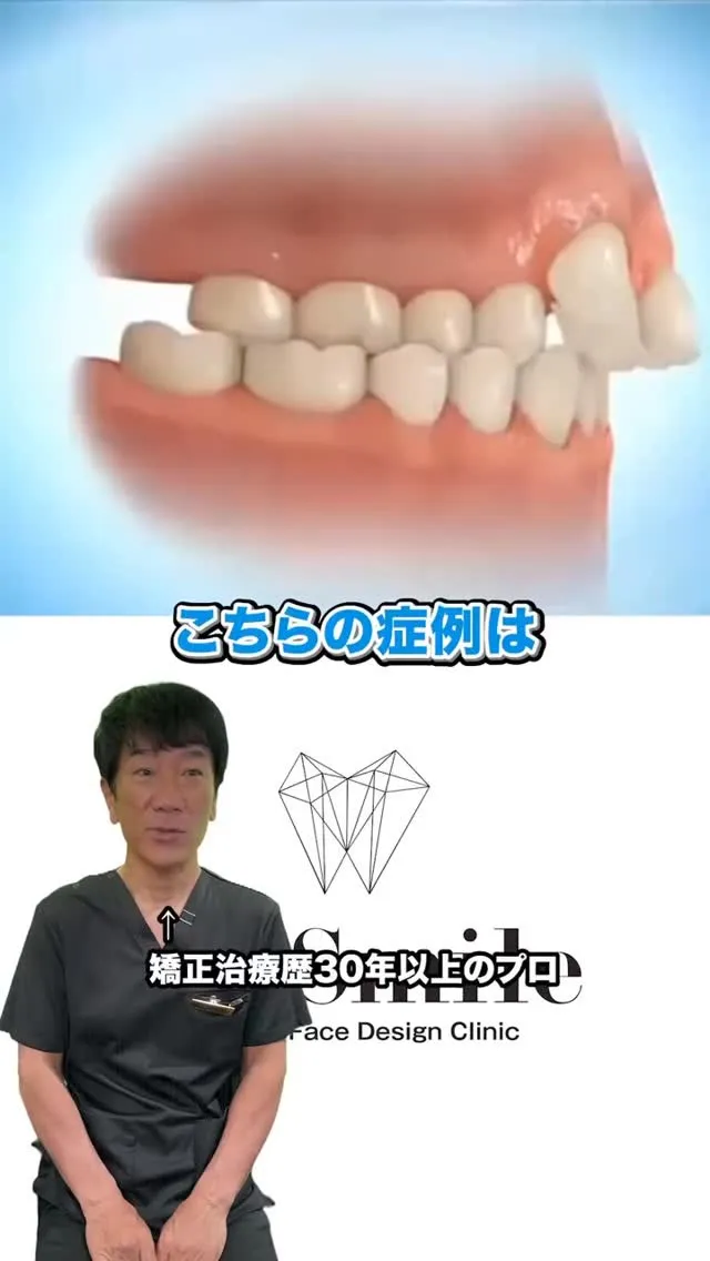 急速拡大装置の解説です！#矯正歯科gosmile横浜 #矯正...