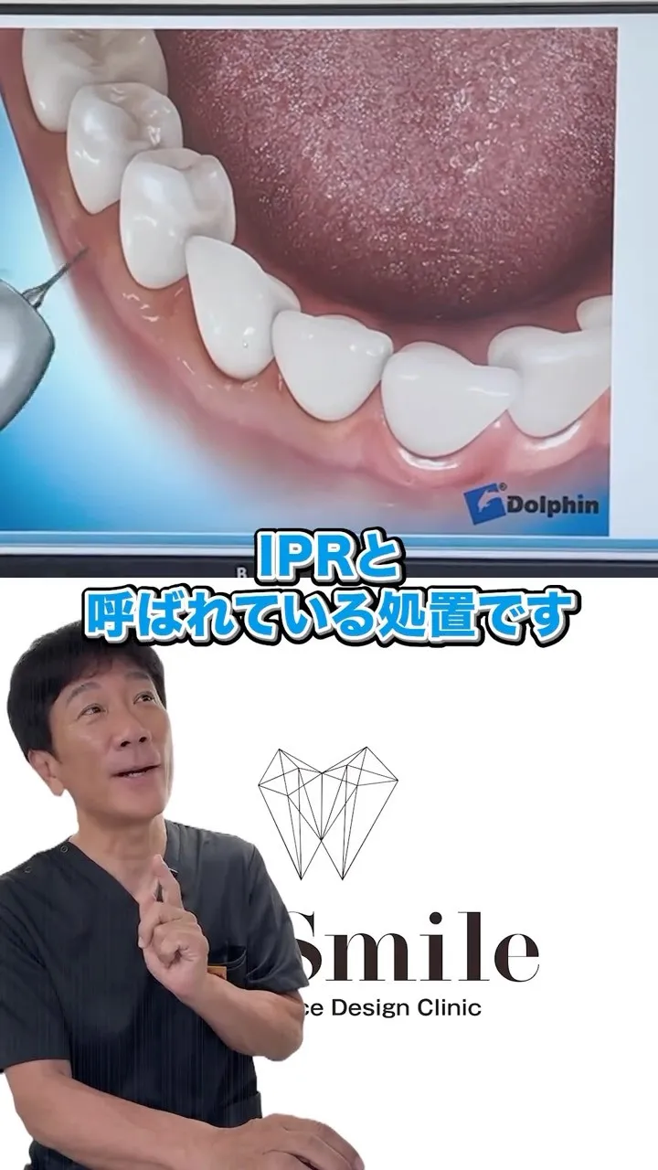 この治療経験したことある人はいますか？#矯正歯科gosmil...