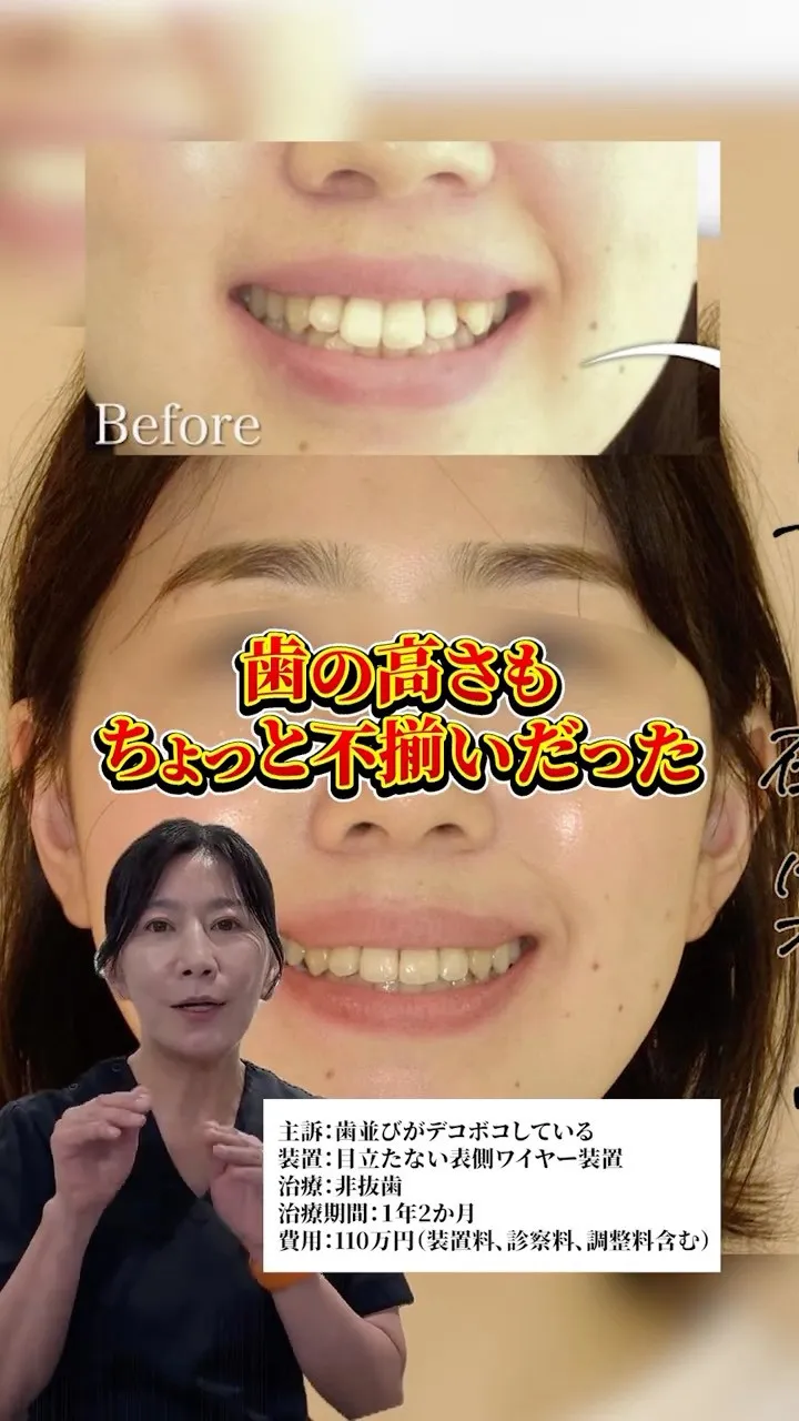 理想の歯並びへ大変身！#矯正歯科gosmile横浜 #矯正歯...