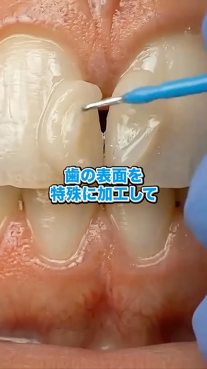 歯の隙間を埋める方法です！#矯正歯科gosmile横浜 #矯...