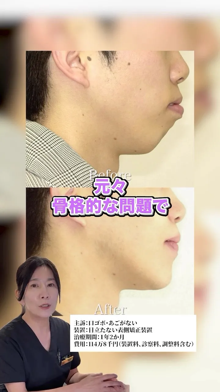 矯正で綺麗な横顔に！